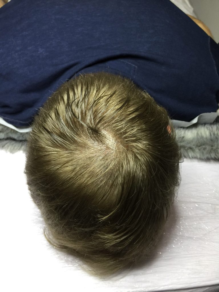 Bald Scalp - SMP - Ttclinic