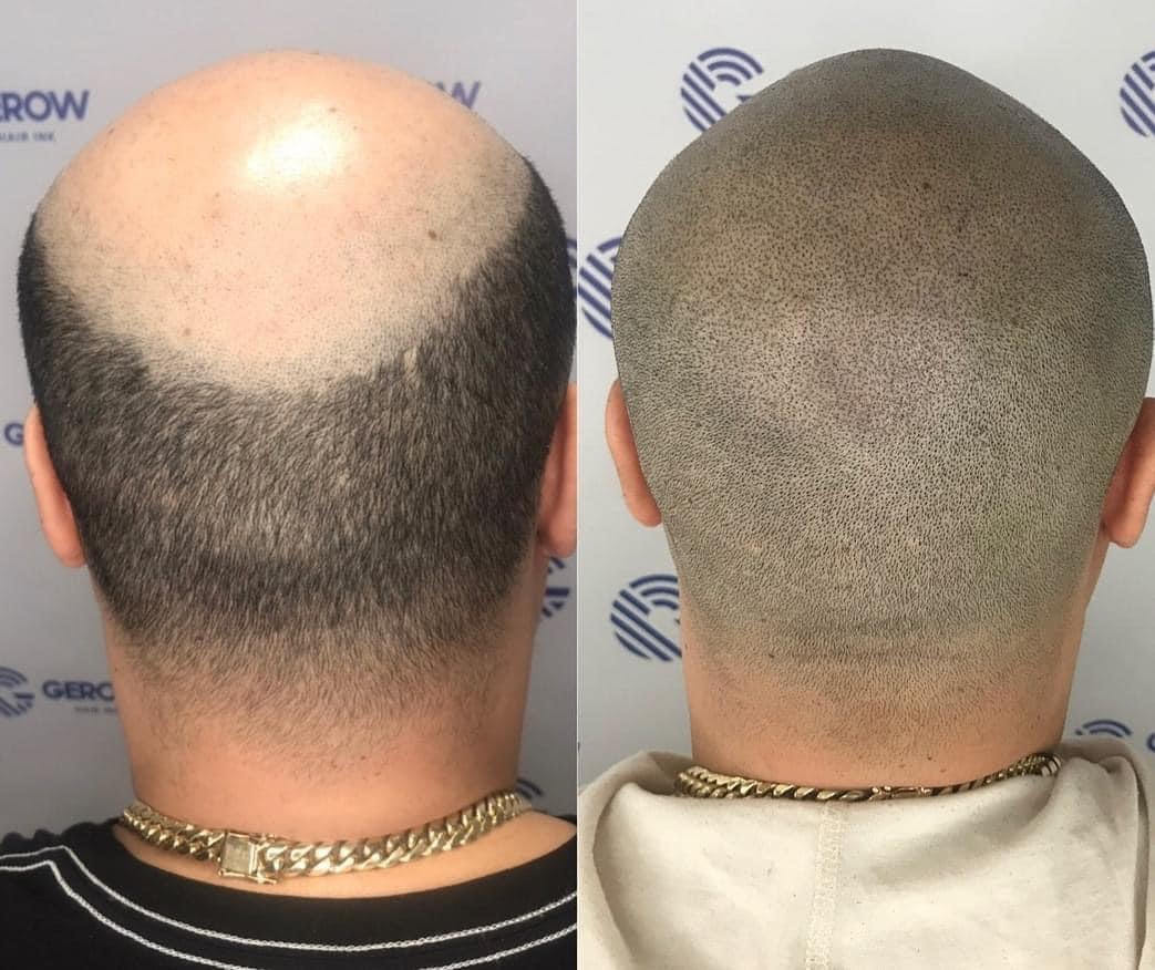 Scalp Society | Scalp Micropigmentation