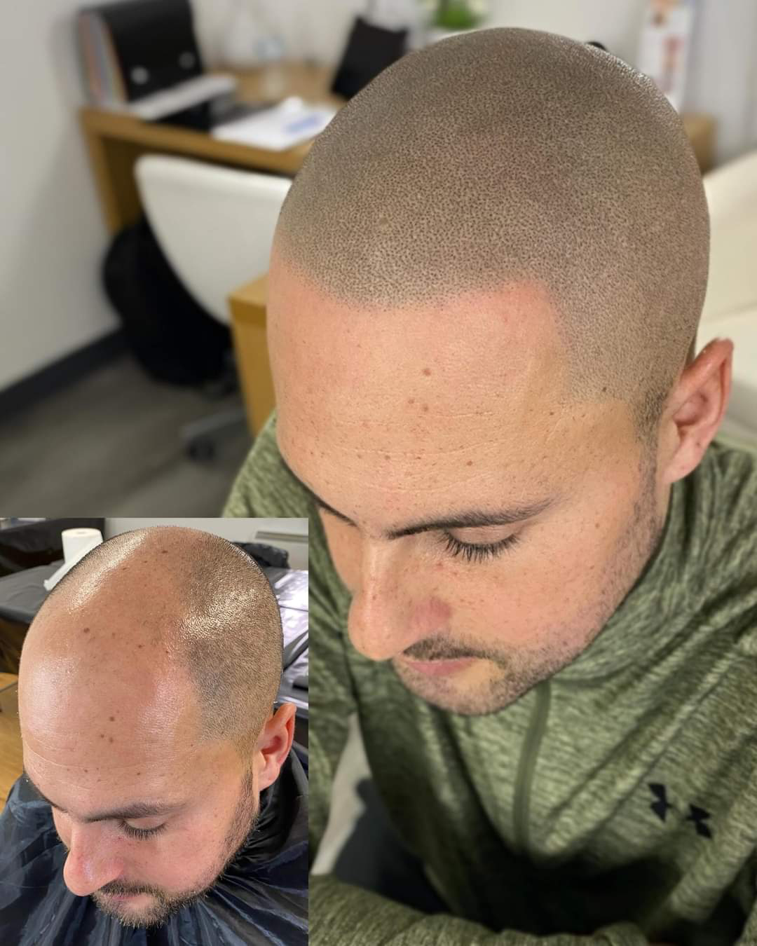 😍HAIR TATTOO RESULTS-SCALP MICROPIGMENTATION