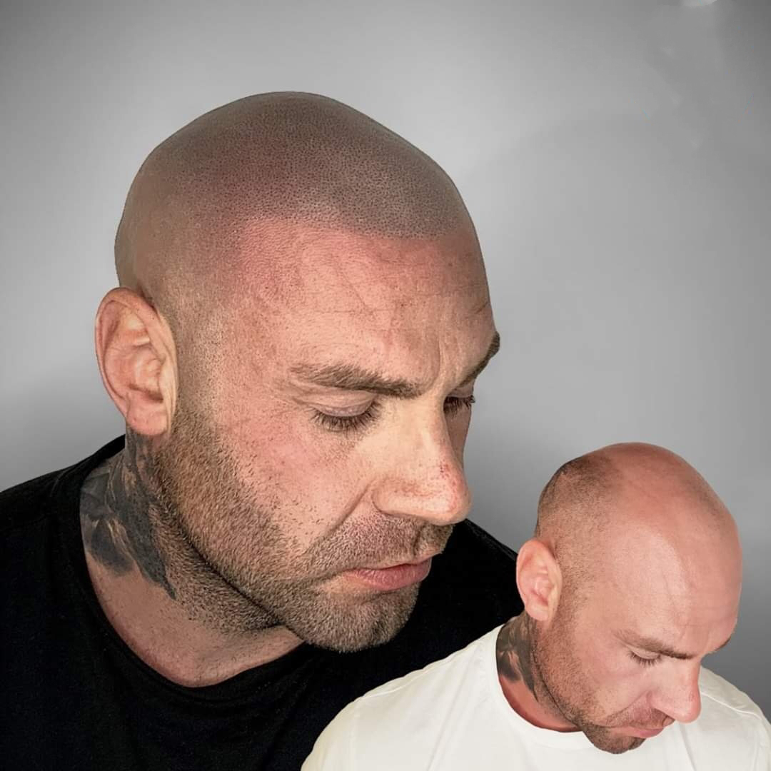 😍HAIR TATTOO RESULTS-SCALP MICROPIGMENTATION